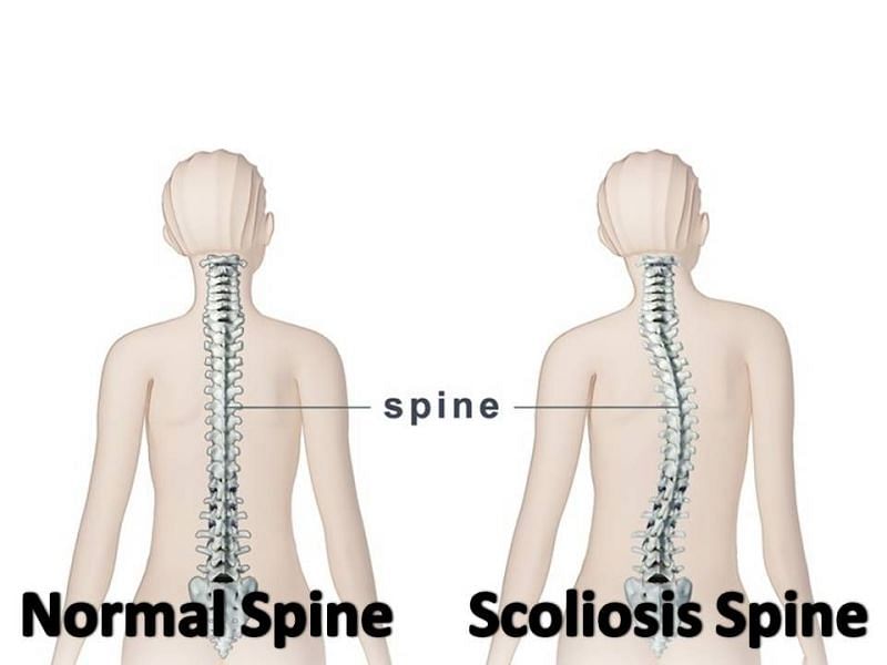 Scoliosis can be dangerous if not monitored adequately