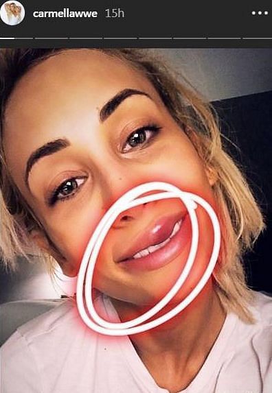 Carmella with a bruised and swollen lip