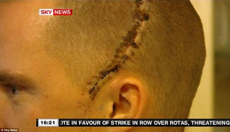 A screengrab from Sky News showing the extent of Iain Hume&#039;s skull injury