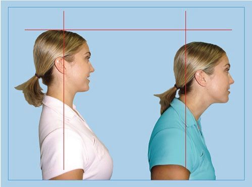 It&#039;s about time that you take notice and correct the forward neck posture