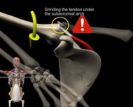 The top of the movement when the supraspinatus tendon rubs against the bone which can cause impingement.
