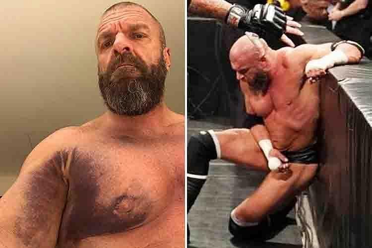 Triple H suffered a serious pectoral injury during his match at Crown Jewel in October.\