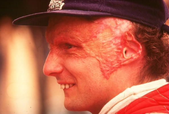 Lauda carried the scars from his 1976 crash for the rest of his life.