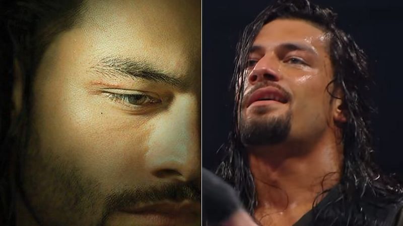 Roman Reigns tried to hide the cut on WWE RAW