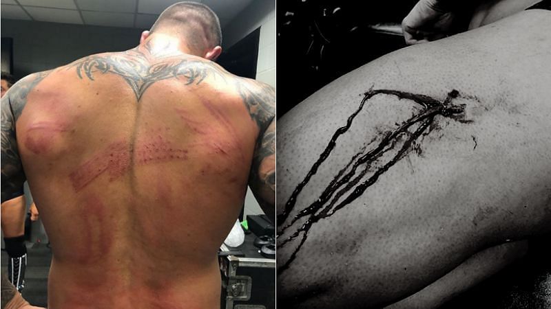 Randy Orton&#039;s injuries (via @RandyOrton - Instagram)