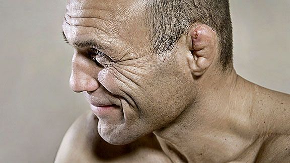 Randy Couture&#039;s cauliflower ears were earned through years of wrestling in the UFC and the gym