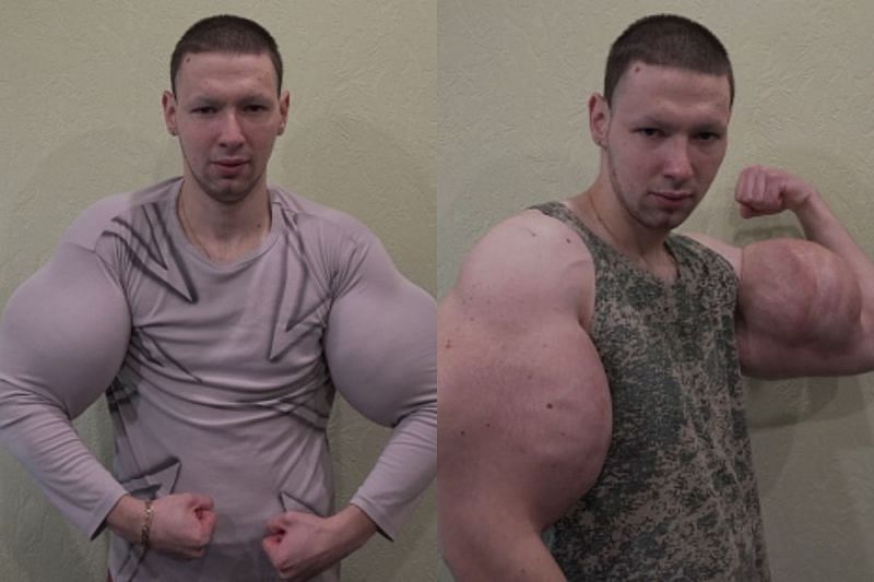 Russian 'Popeye' Proudly Maintains His Synthol-Induced 24-Inch Freakish  Biceps Despite Suffering From Health Issues in the Past - EssentiallySports