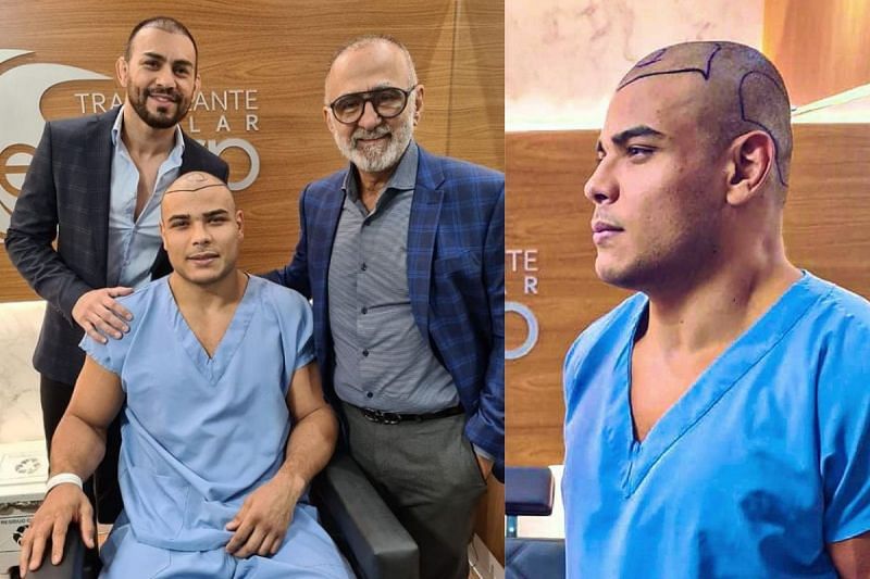 Paulo Costa undergoes hair transplant surgery [Image credit: @drpablomilhomem via Instagram]