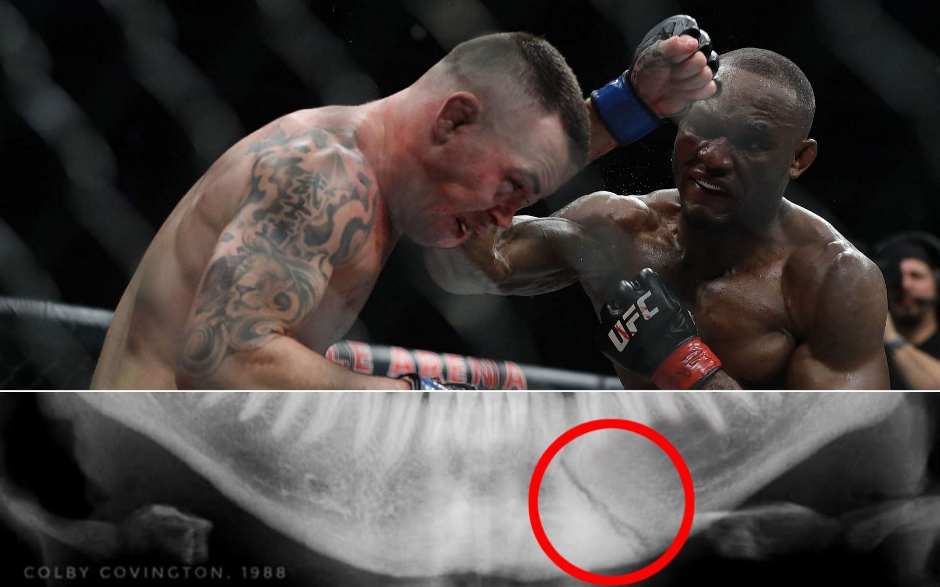 The supposed X-ray of Colby Covington&#039;s broken jaw [Photo credit: sportsmanor.com]