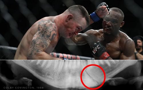 The supposed X-ray of Colby Covington's broken jaw [Photo credit: sportsmanor.com]