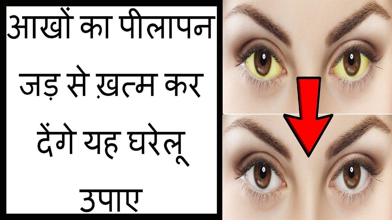आंखों का पीलापन कैसे दूर करें(फोटो:youtube)