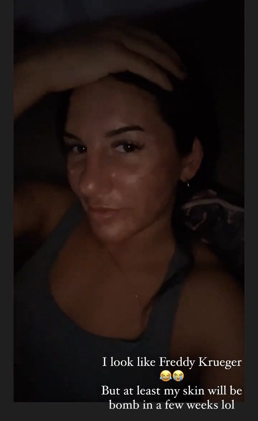 Cheyanne Vlismas took to her Instagram stories to post pictures of her face after the treatment.