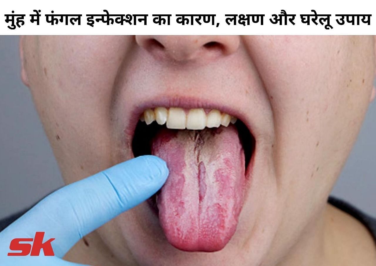 मुंह में फंगल इन्फेक्शन का कारण, लक्षण और घरेलू उपाय (फोटो - sportskeeda hindi)