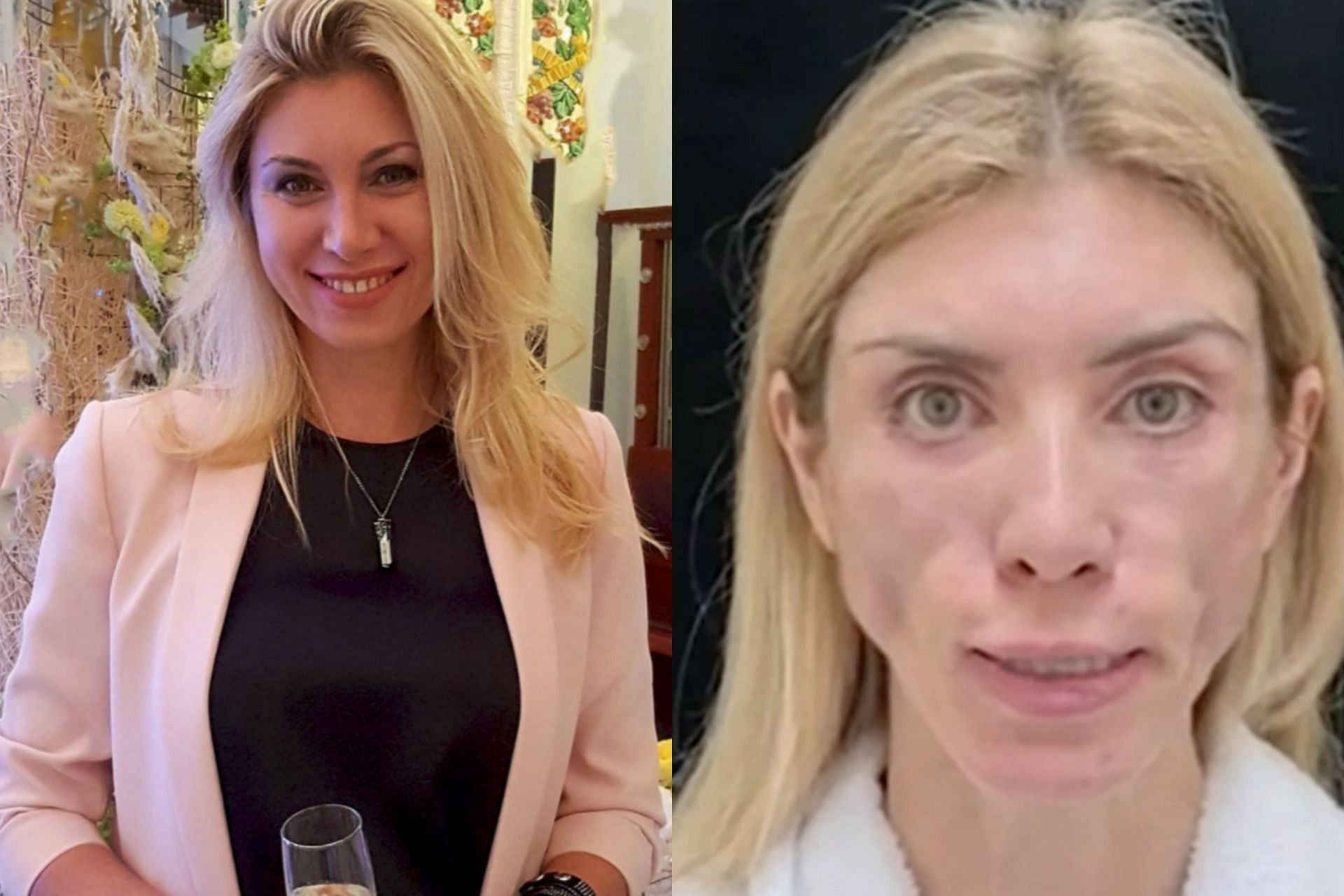 Russian beauty queen to sue plastic surgeons following botched surgery (Image via East2West)