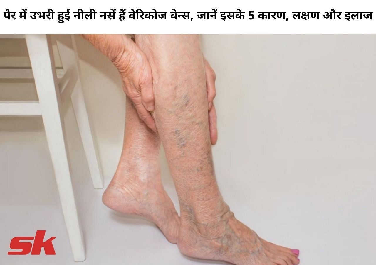 पैर में उभरी हुई नीली नसें हैं वेरिकोज वेन्स, जानें इसके 5 कारण, लक्षण और इलाज (फोटो - sportskeeda hindi)