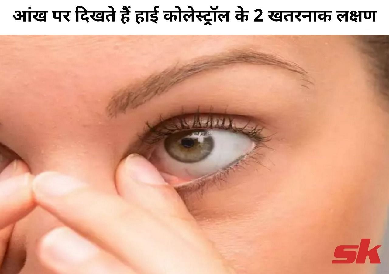 आंख पर दिखते हैं हाई कोलेस्ट्रॉल के 2 खतरनाक लक्षण (फोटो - sportskeeda hindi)