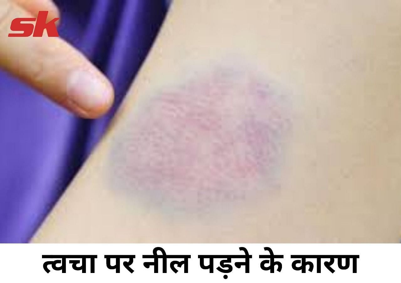 त्वचा पर नीले निशान पड़ने (Bruises) के क्या कारण (फोटो - sportskeeda hindi)