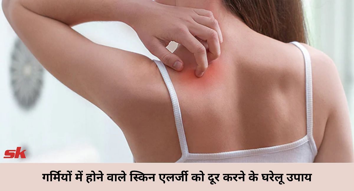 गर्मियों में होने वाले स्किन एलर्जी को दूर करने के घरेलू उपाय(फोटो-Sportskeeda hindi)