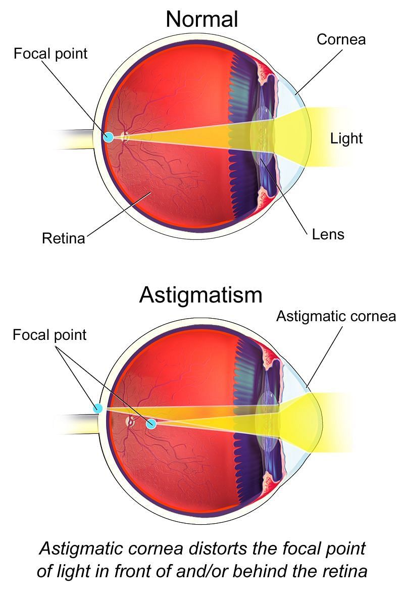The human eye with Astigmatism diagnosis (Image via BruceBlaus/Wikipedia)