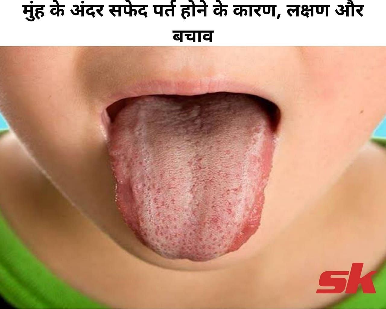 मुंह के अंदर सफेद पर्त होने के कारण, लक्षण और बचाव (फोटो - sportskeeda hindi)