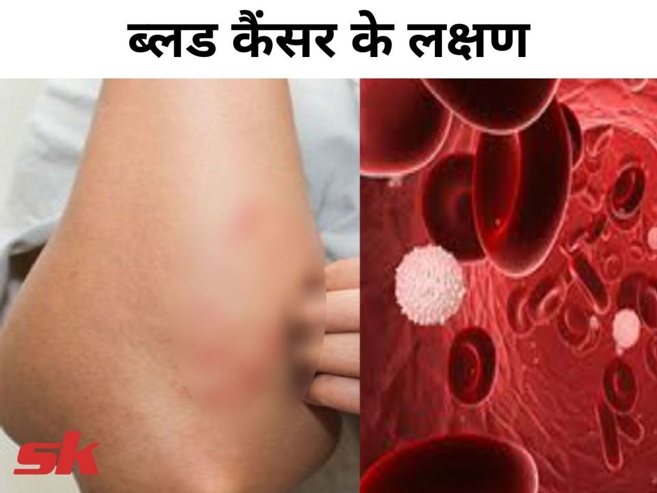 blood-cancer-ke-lakshan-in-hindi