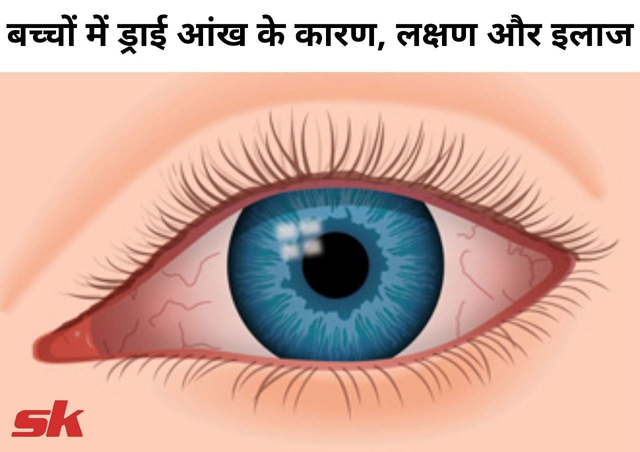 बच्चों में ड्राई आंख के कारण, लक्षण और इलाज (फोटो - sportskeeda hindi)
