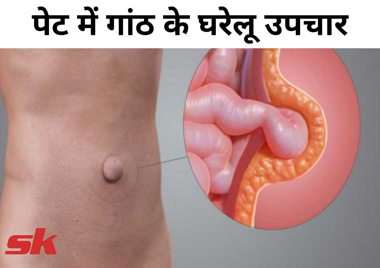 पेट में गांठ के घरेलू उपचार (फोटो - sportskeeda hindi)