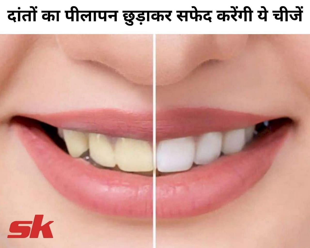 दांतों का पीलापन छुड़ाकर सफेद करेंगी ये चीजें (फोटो - sportskeeda hindi)