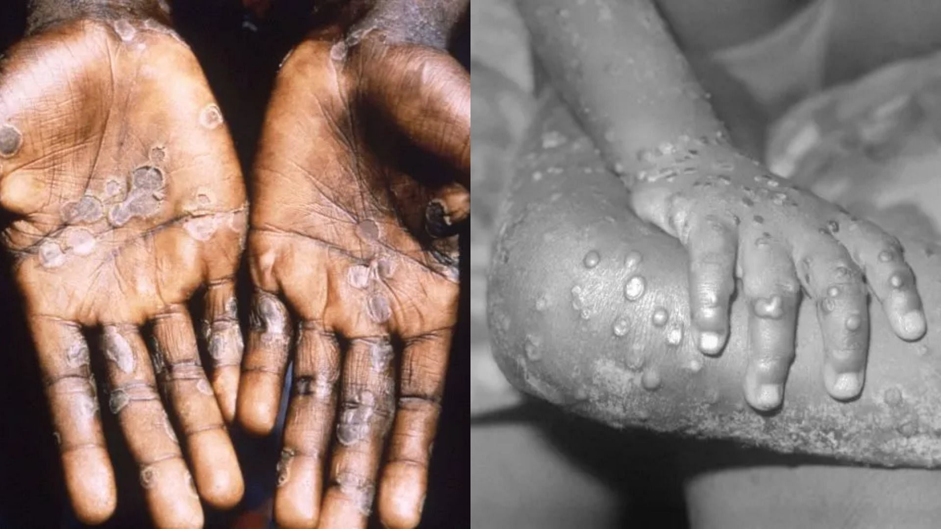WHO debunks claims that monkeypox is exclusively a &#039;gay disease&#039; (Images via Getty Images)