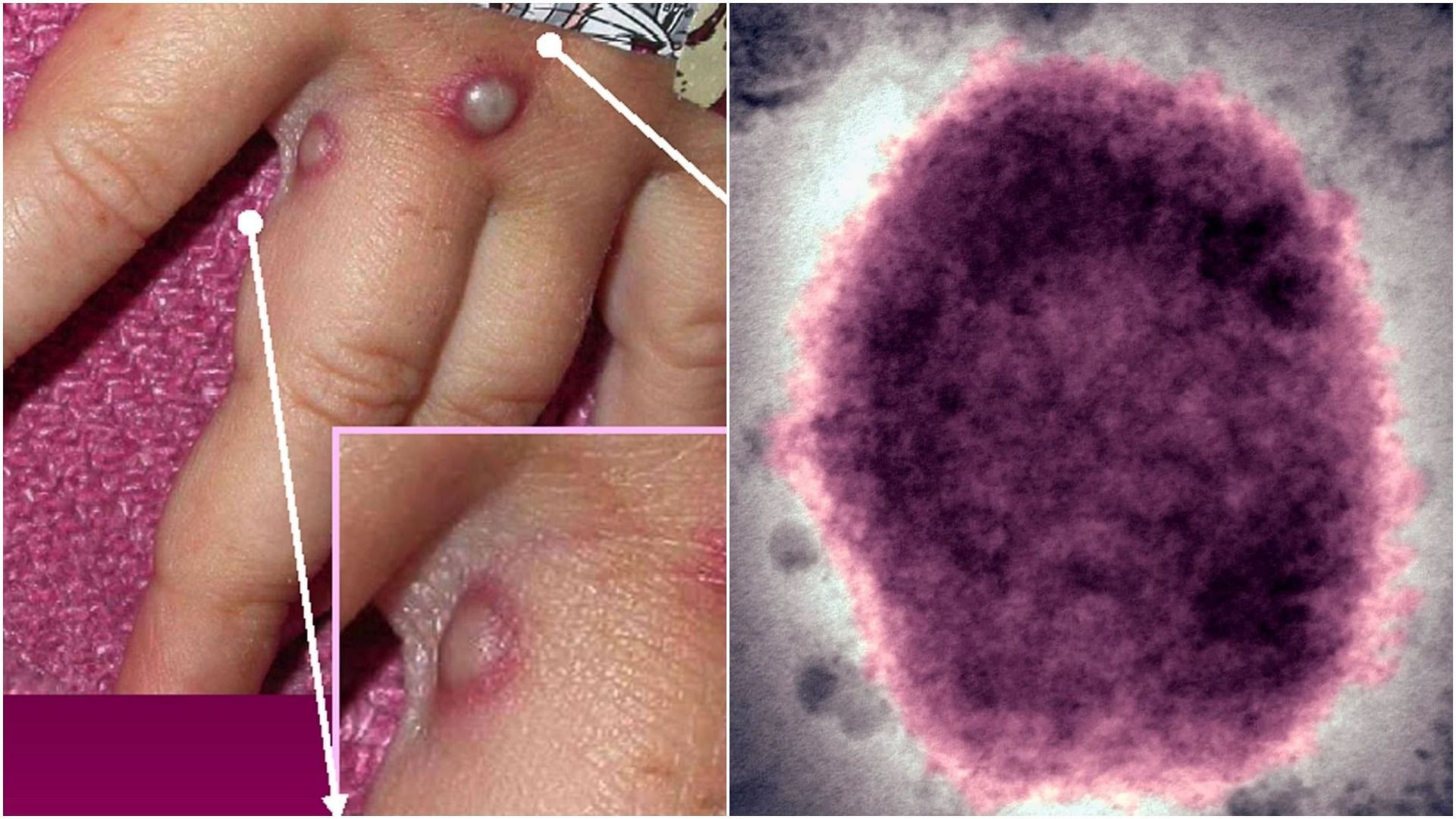 Bumps caused by MPV (Image via Getty Images, and Universal Images Group/Getty Images)