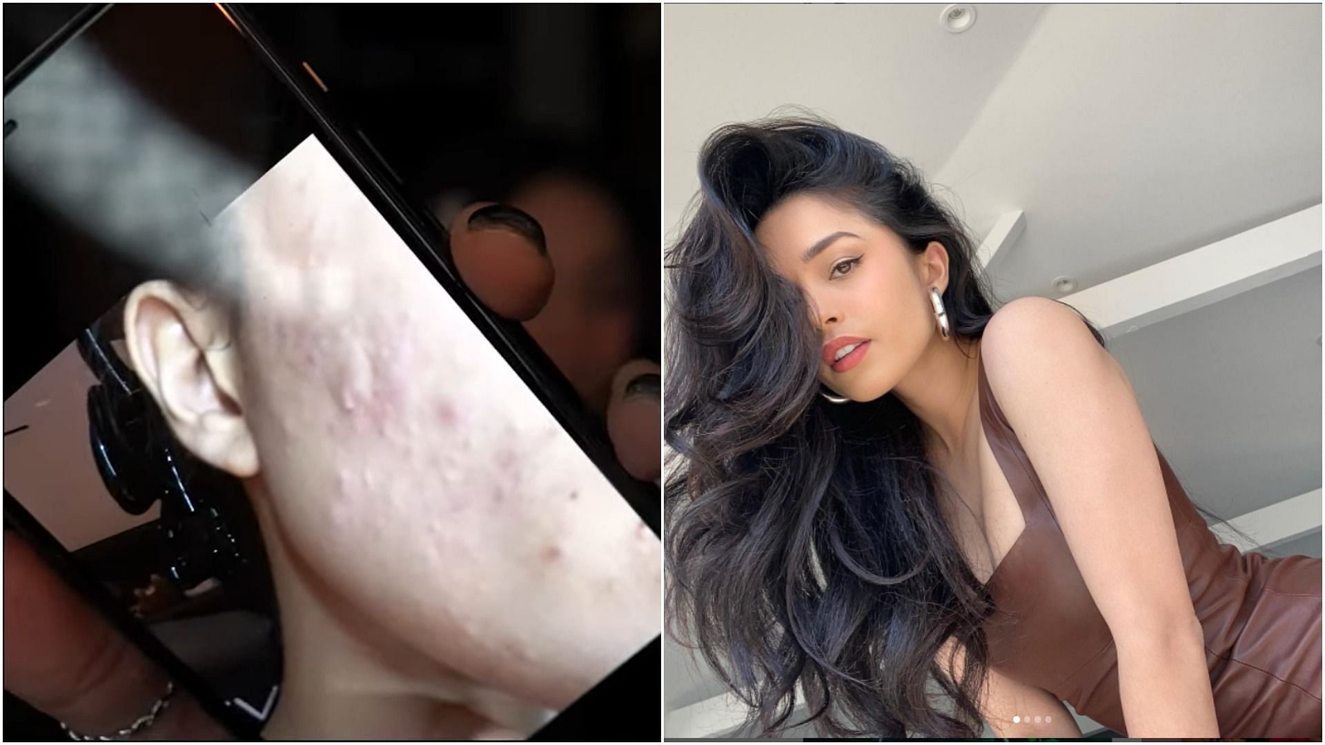 Rae opens up to her fans about the skin problems she faces regularly (Image via- Valkyrae/YouTube, Instagram)