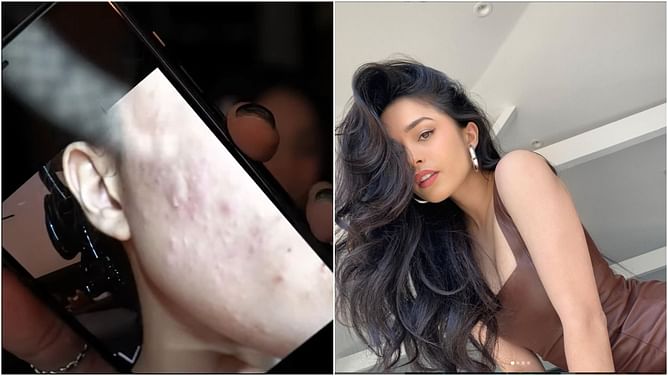 "I'm really insecure about it"- Valkyrae opens up to her fans about the skin problems she faces regularly