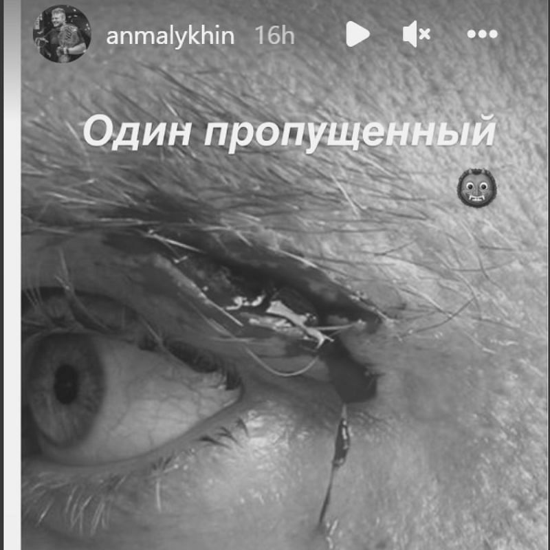 Anatoly Malykhin shows off his gash (Image from @anmalykhin Instagram story)