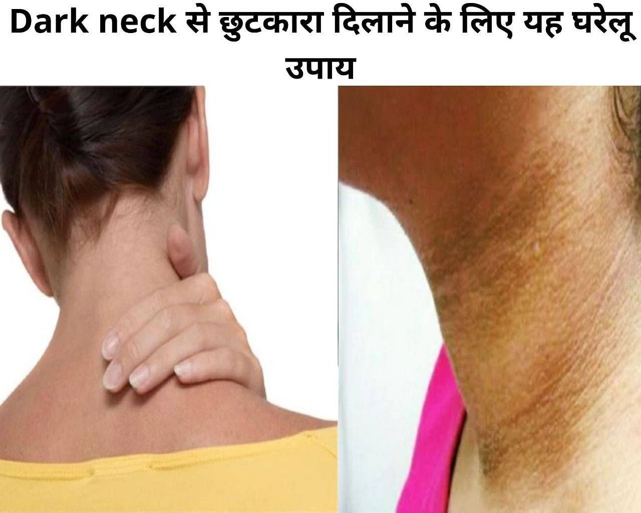 Dark neck से छुटकारा दिलाने के लिए यह घरेलू उपाय (फोटो - sportskeeda hindi)