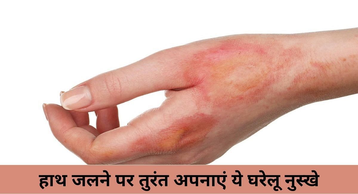 हाथ जलने पर तुरंत अपनाएं ये घरेलू नुस्खे(फोटो-Sportskeeda hindi)