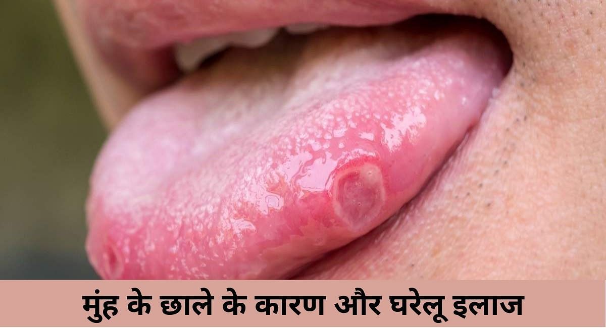 मुंह के छाले के कारण और घरेलू इलाज(फोटो-Sportskeeda hindi)