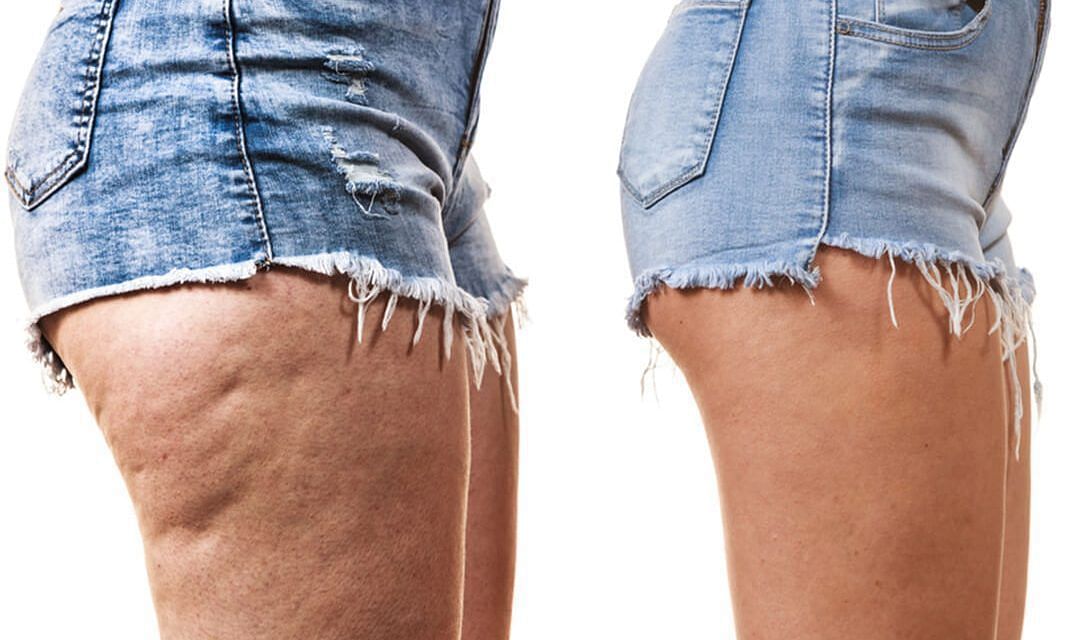 7 Best Workouts You Can Do to Get Rid of Cellulite