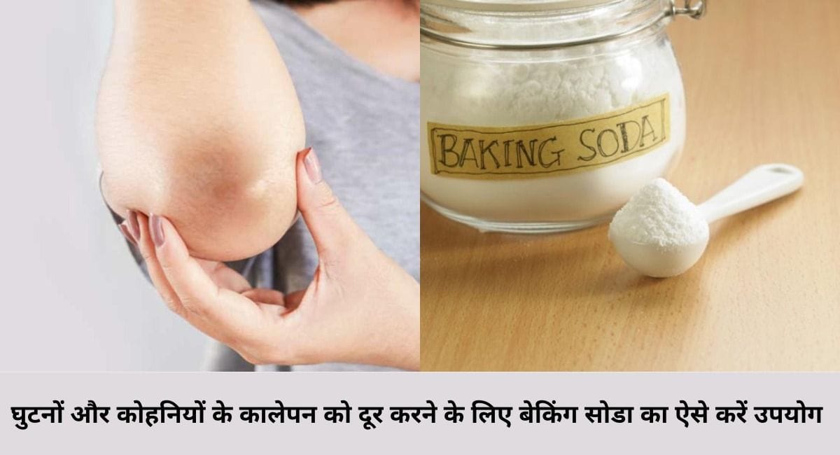 घुटनों और कोहनियों के कालेपन को दूर करने के लिए बेकिंग सोडा का ऐसे करें