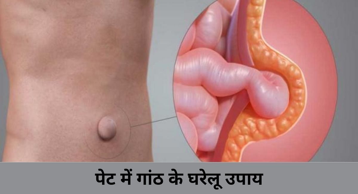 पेट में गांठ के घरेलू उपाय (फोटो - sportskeeda hindi)
