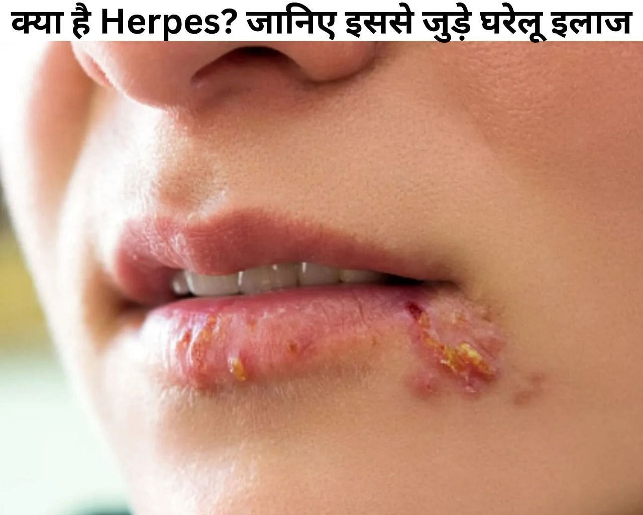 क्या है Herpes? जानिए इससे जुड़े घरेलू इलाज (फोटो - sportskeedaहिंदी)