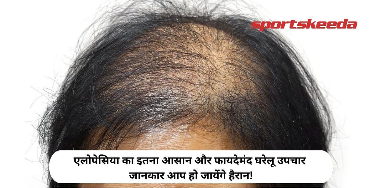 You will be surprised to know such easy and beneficial home remedies for Alopecia!