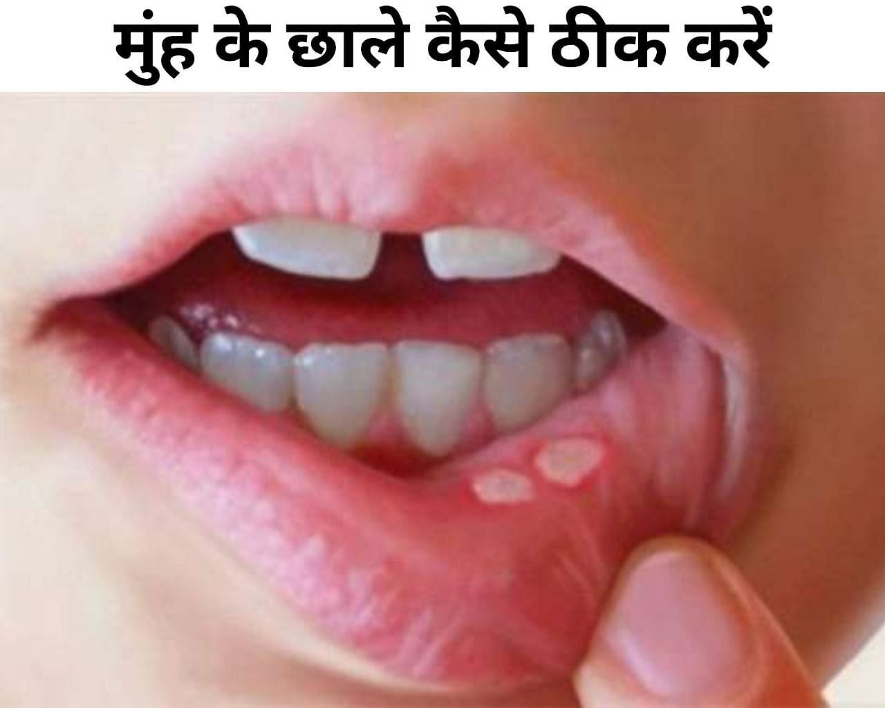मुंह के छाले कैसे ठीक करें (फोटो - sportskeeda hindi)