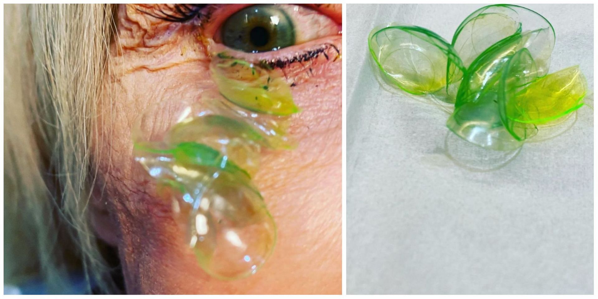 An ophthalmologist from California shared a bizarre video of a woman with 23 contact lenses in her eye. (Image via Instagram)