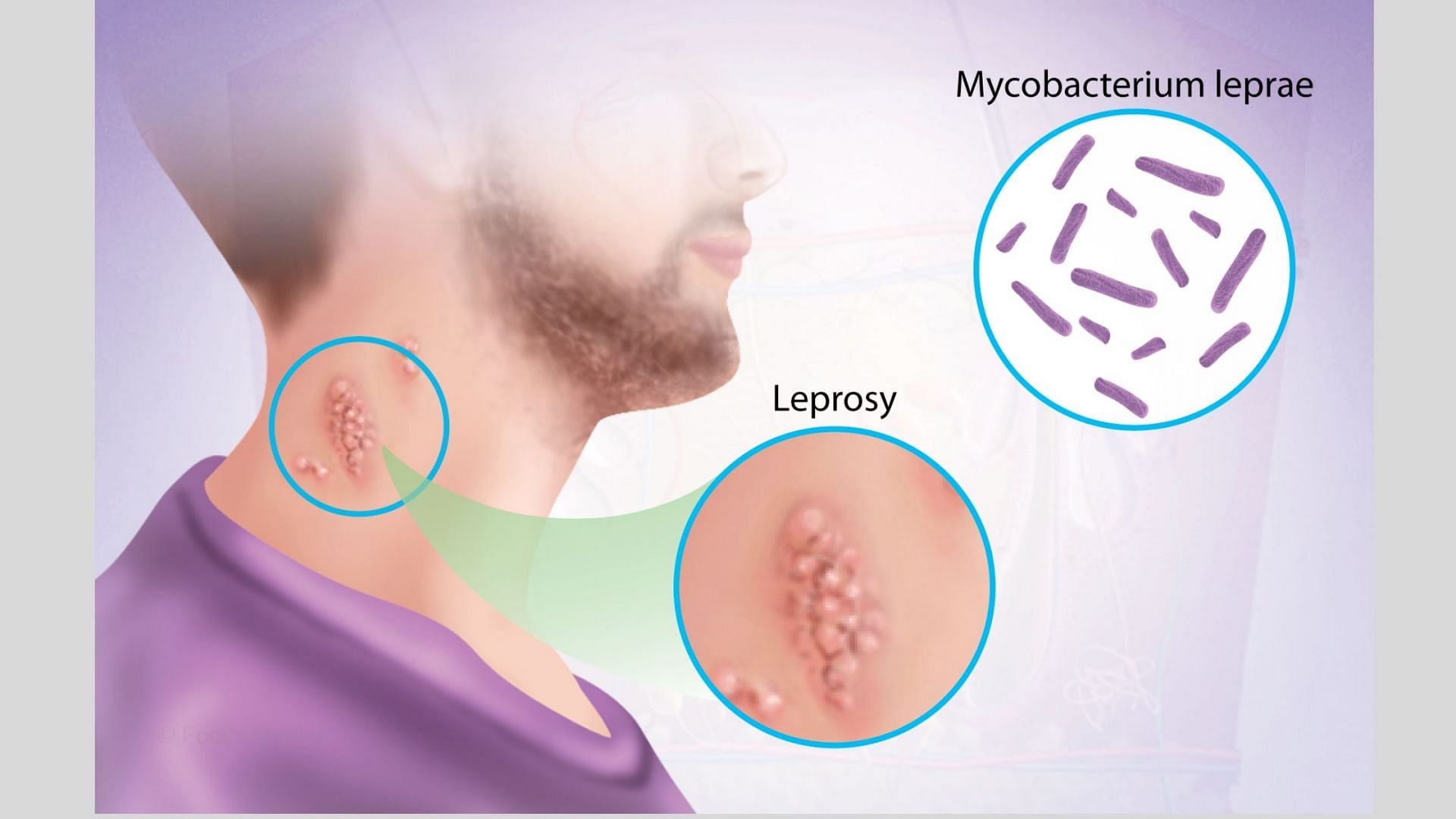 Symptoms of leprosy (image via MSN)