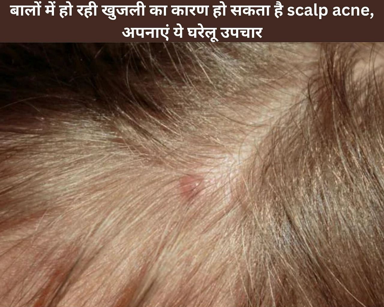 बालों में हो रही खुजली का कारण हो सकता है scalp acne, अपनाएं ये 4 घरेलू उपचार ()