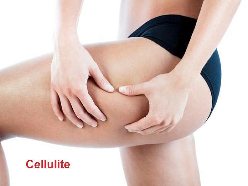 The appearance of cellulite can be reduced through muscle-building exercises (Image via Flickr @My Fresh Skin)