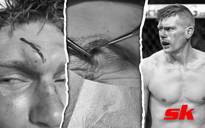 VIDEO: Close-up look at 'Wonderboy' Stephen Thompson getting stitches for nasty cuts suffered at UFC Orlando (GRAPHIC WARNING)