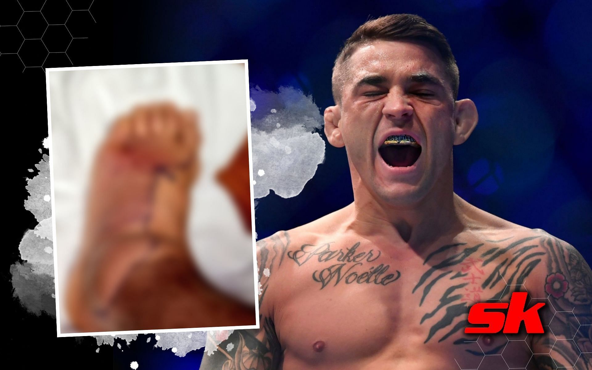 Dustin Poirier shares graphic update on staph infection as his foot seemingly continues to swell