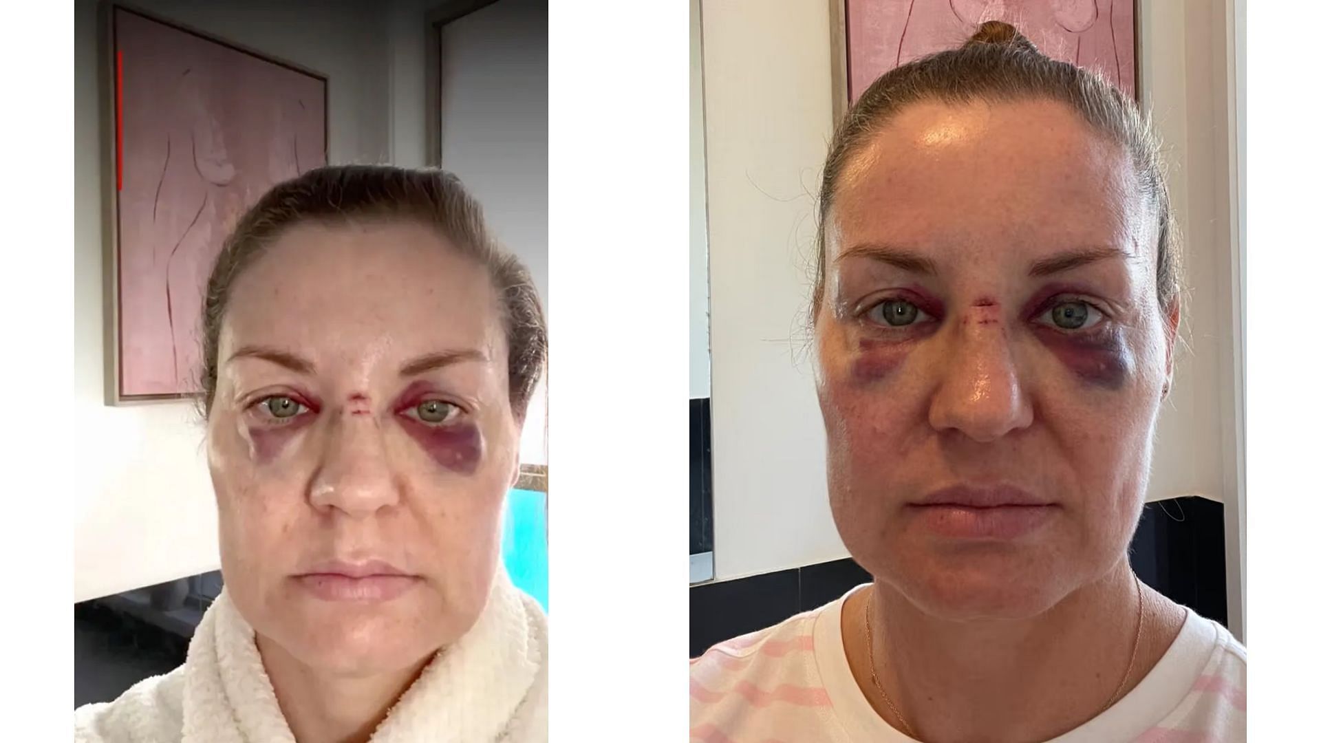 Rebecca Howe shared images of her face post injury (Image via TikTok)