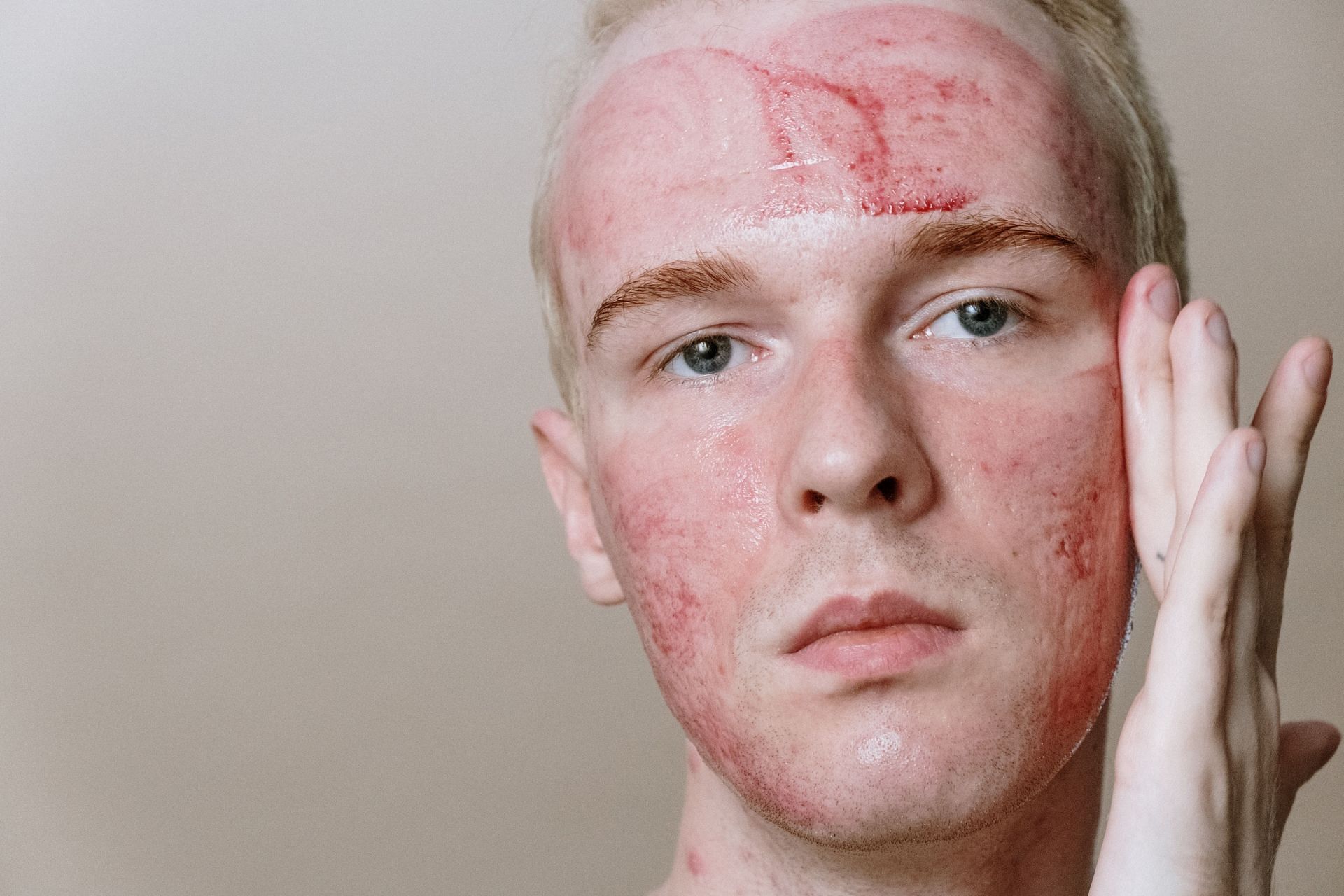 Red, inflamed patches on skin are common symptoms of rosacea (Image via Pexels/Cottonbro Studio)